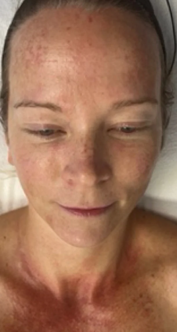 Before treatment 6