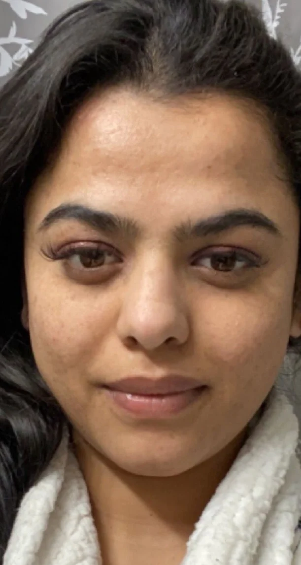After treatment 3