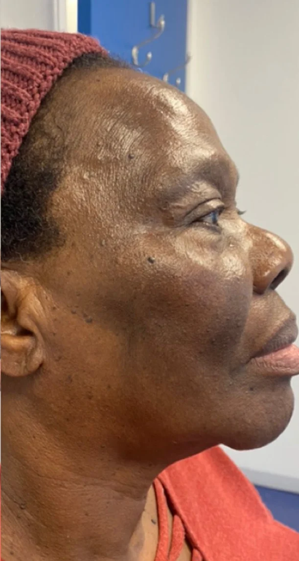 After treatment 10