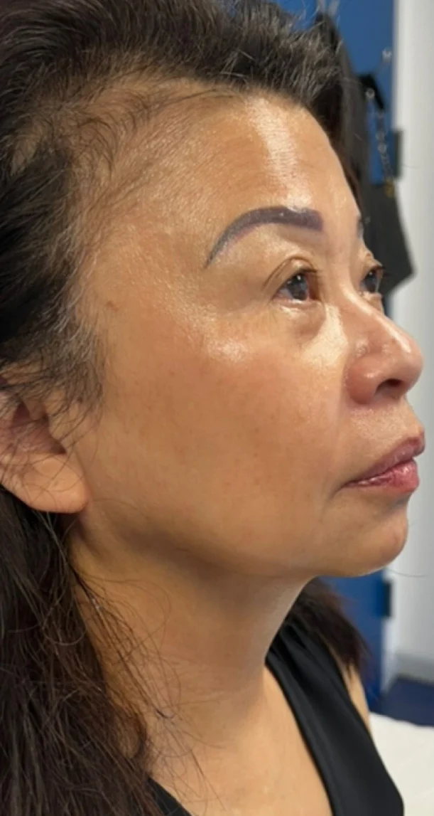 After treatment 3