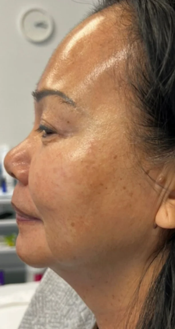 After treatment 2
