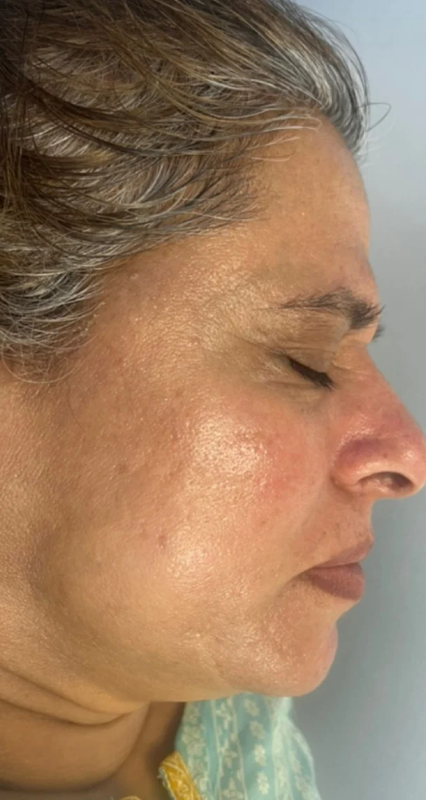 After treatment 4