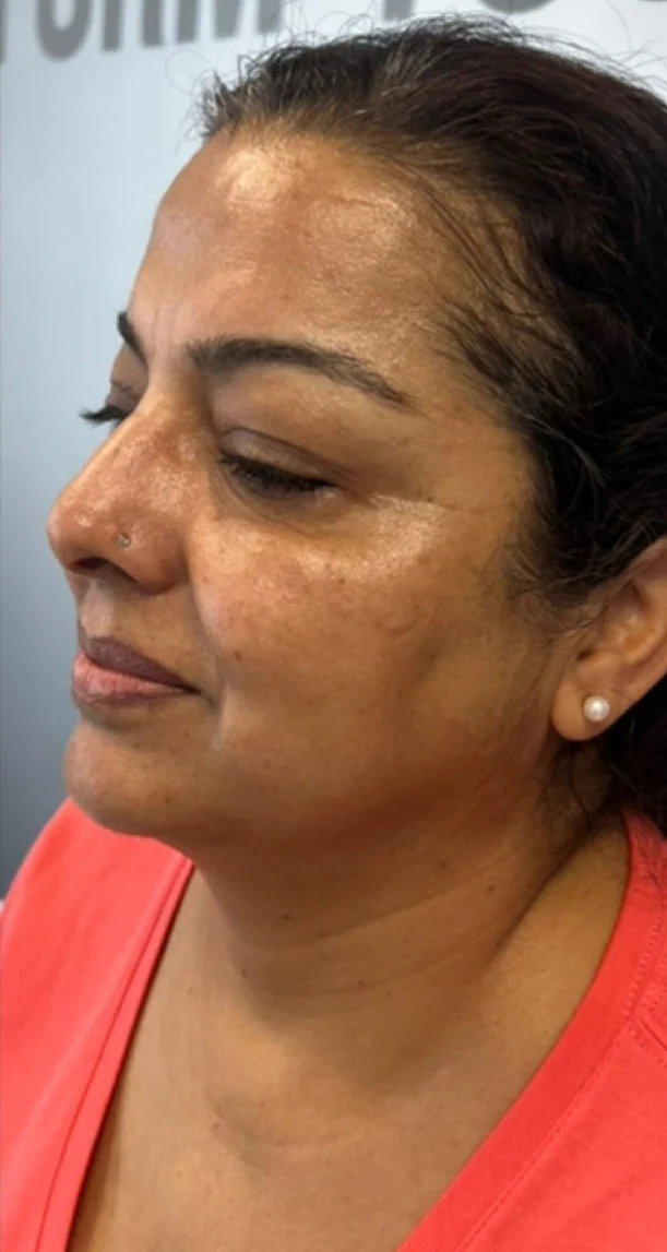After treatment 1